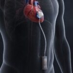 Iten adapte ses micro-batteries solides aux implants médicaux de classe III